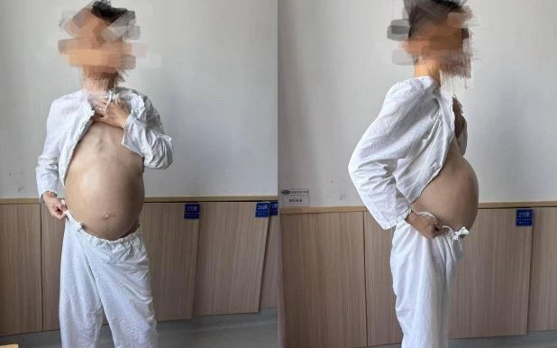 Người đàn ông 40 tuổi bụng to như mang bầu, khi phẫu thuật bác sĩ phát hiện điều đáng sợ