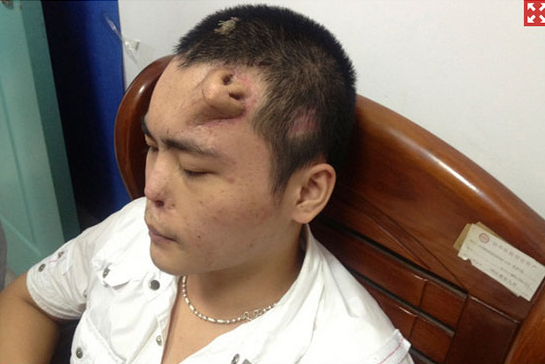 Kh&ocirc;ng phải ảnh lỗi của AI, người đ&agrave;n &ocirc;ng n&agrave;y đ&atilde; thực sự mọc một chiếc mũi tr&ecirc;n tr&aacute;n: Đ&oacute; l&agrave; "t&aacute;c phẩm" của c&aacute;c b&aacute;c sĩ Trung Quốc- Ảnh 1.