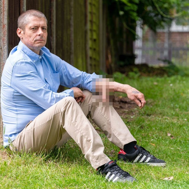 Kh&ocirc;ng phải ảnh lỗi của AI, người đ&agrave;n &ocirc;ng n&agrave;y đ&atilde; thực sự mọc một chiếc mũi tr&ecirc;n tr&aacute;n: Đ&oacute; l&agrave; "t&aacute;c phẩm" của c&aacute;c b&aacute;c sĩ Trung Quốc- Ảnh 7.