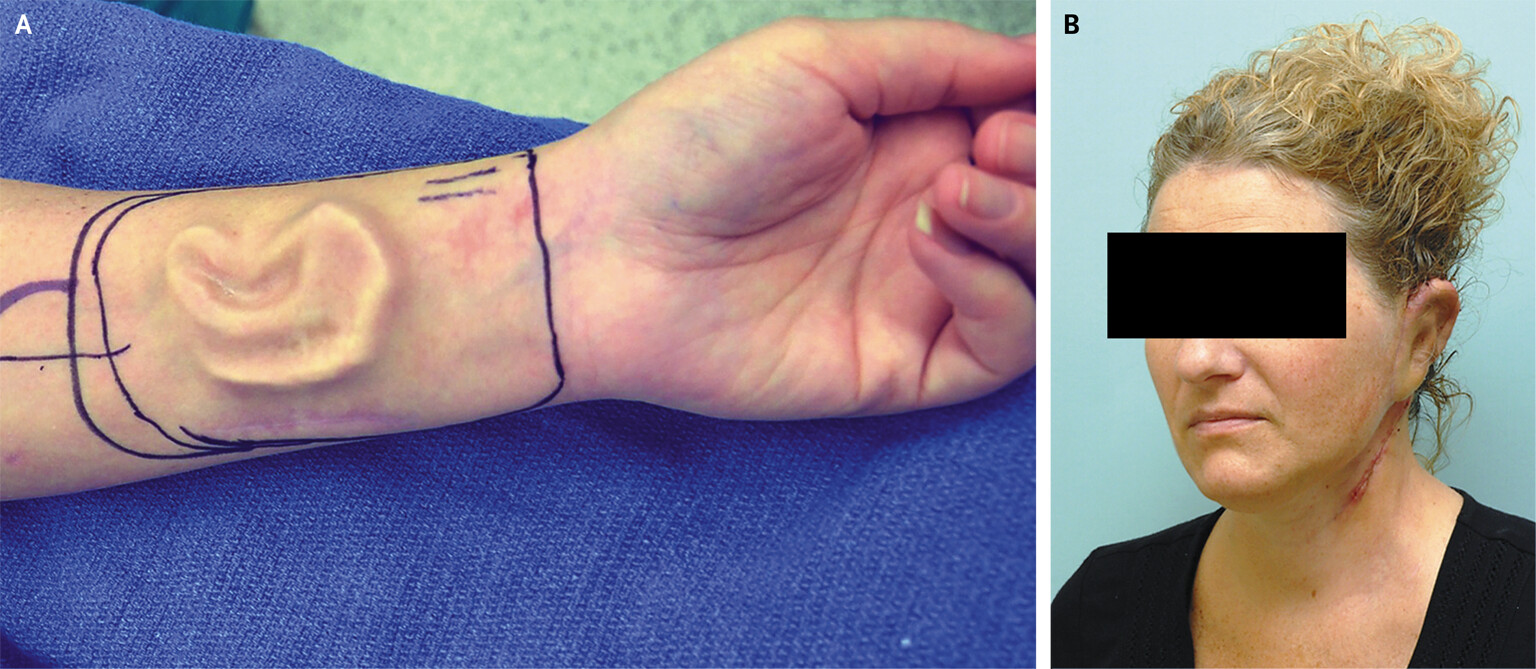 Kh&ocirc;ng phải ảnh lỗi của AI, người đ&agrave;n &ocirc;ng n&agrave;y đ&atilde; thực sự mọc một chiếc mũi tr&ecirc;n tr&aacute;n: Đ&oacute; l&agrave; "t&aacute;c phẩm" của c&aacute;c b&aacute;c sĩ Trung Quốc- Ảnh 6.