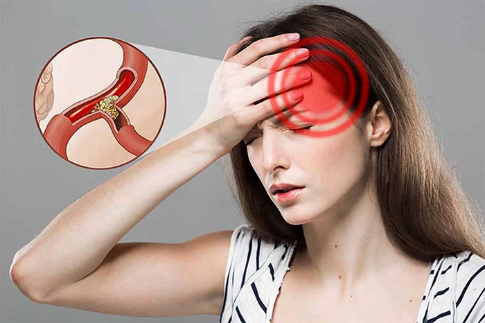 Ngày càng nhiều người bị nhồi máu não: Cảnh giác 3 loại gia vị là Ngày càng nhiều người bị nhồi máu não: Cảnh giác 3 loại gia vị là