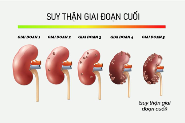 Nữ diễn vi&ecirc;n phim "Mai" bị suy thận giai đoạn cuối ở tuổi 29: Phương ph&aacute;p điều trị l&agrave; g&igrave;?- Ảnh 2.