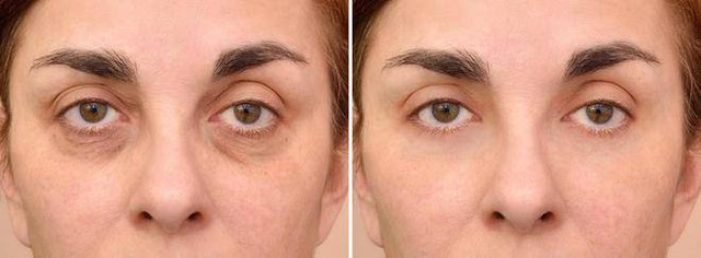 Không gặp 5 bất thường này buổi sáng thì chúc mừng bạn có thận khỏe mạnh, thấy