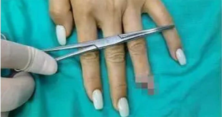 Bị gãy ngón tay do kẹp cửa vì sơn móng tay quá dày - Ảnh 2.