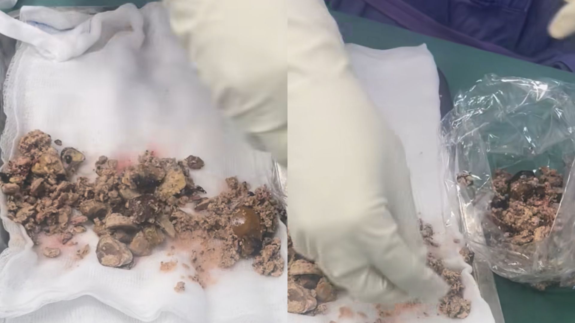 Mới 20 tuổi đã đột quỵ: Cơ thể gửi tín hiệu cảnh báo khi dùng điện thoại nhưng bị "làm ngơ" - Ảnh 3.