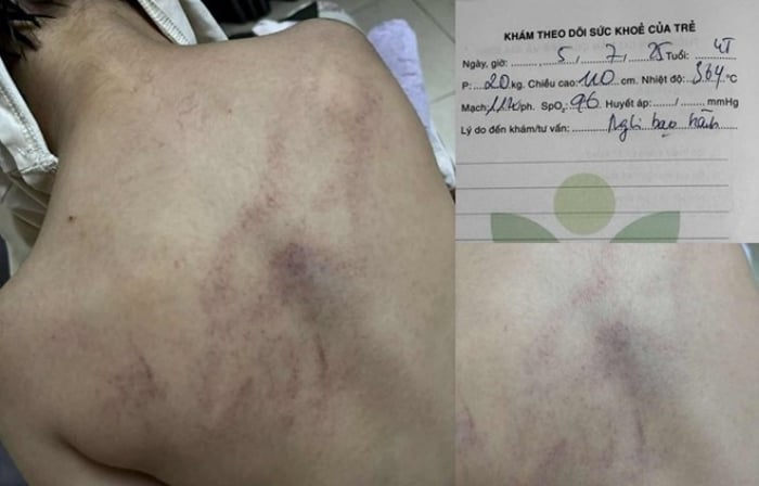 Bé gái 4 tuổi bị cô giáo bạo hành ở Hà Nội gây chấn động dư luận - Ảnh 1.