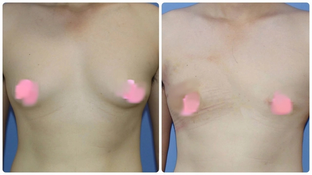 Nam thanh niên khổ sở vì ngực to bất thường- Ảnh 2.