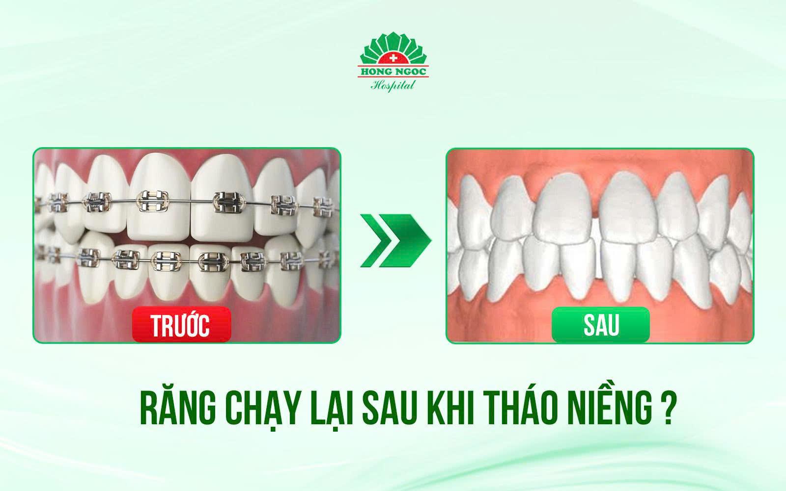 Niềng răng đẹp thôi chưa đủ - Cần chuẩn khớp cắn hạng I và bền vững lâu dài - Ảnh 2.