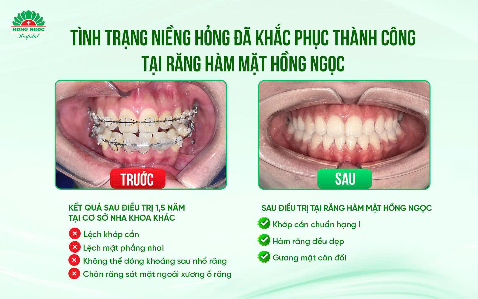 Niềng răng đẹp thôi chưa đủ - Cần chuẩn khớp cắn hạng I và bền vững lâu dài - Ảnh 4.