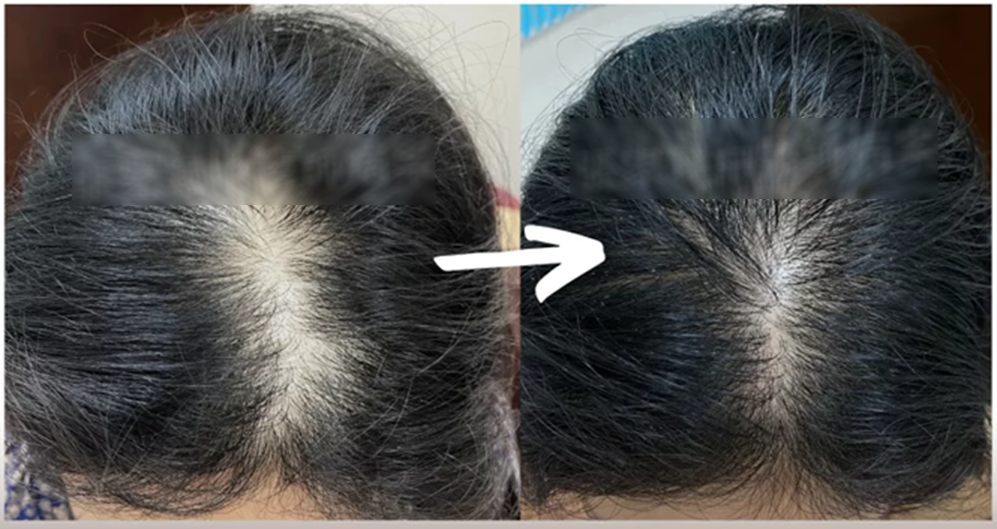 Cô gái 29 tuổi tóc đã rụng hói đầu, bác sĩ: Ngăn ngừa rụng tóc, kích thích mọc tóc cần tránh xa những thứ này- Ảnh 1. Cô gái 29 tuổi tóc đã rụng hói đầu, bác sĩ: Ngăn ngừa rụng tóc, kích thích mọc tóc cần tránh xa những thứ này- Ảnh 1.