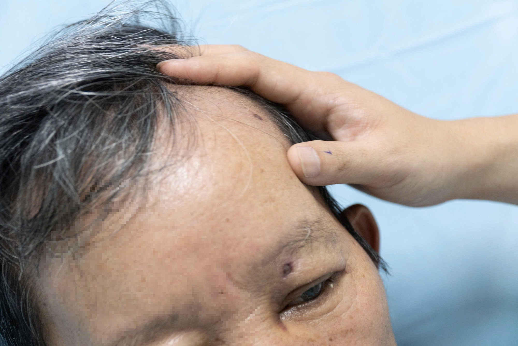 Người đàn ông ở Đà Nẵng bị ong đốt đến hôn mê, suýt chết - Ảnh 2.