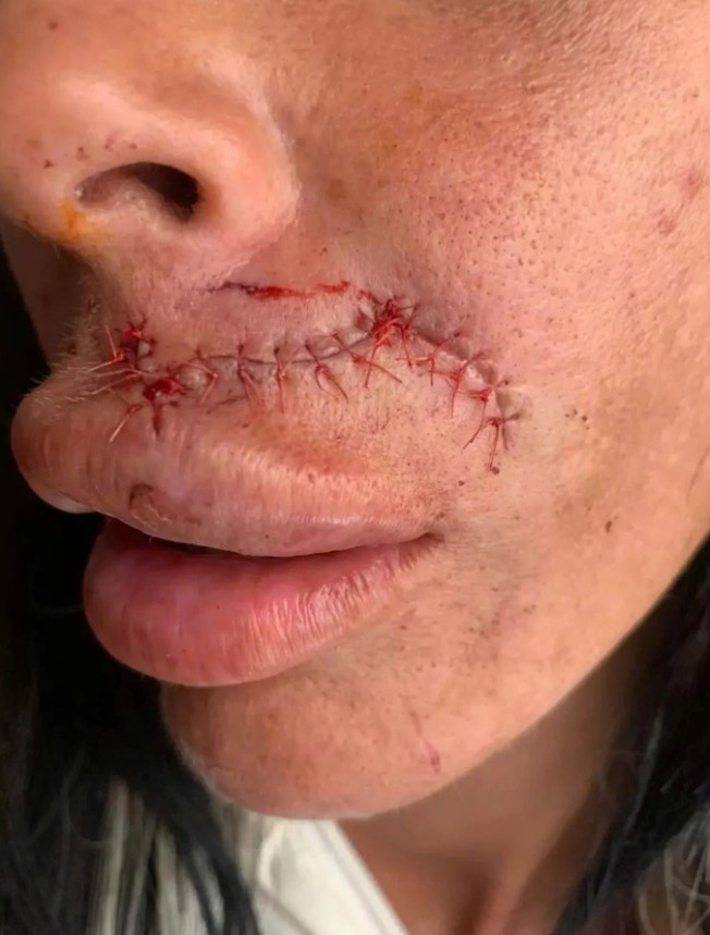 Người phụ nữ bị chó Pitbull cắn biến dạng khuôn mặt giữa phố Liverpool - Ảnh 2.