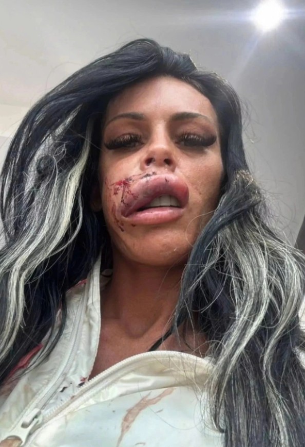 Người phụ nữ bị chó Pitbull cắn biến dạng khuôn mặt giữa phố Liverpool - Ảnh 1.