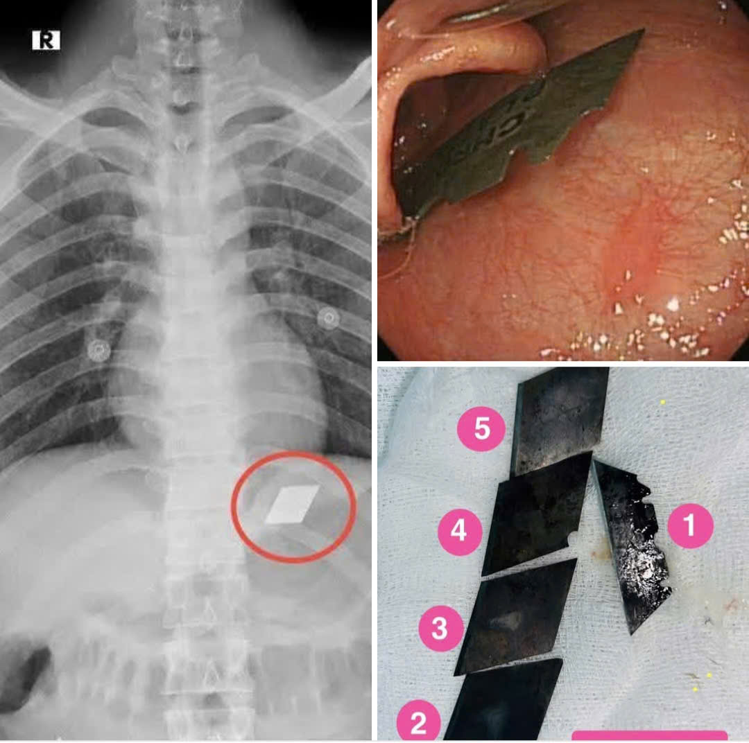 H&atilde;i h&ugrave;ng một bệnh nh&acirc;n "ng&aacute;o đ&aacute;" ở TP HCM nuốt trọn bộ dao 5 m&oacute;n v&agrave;o bụng- Ảnh 1.