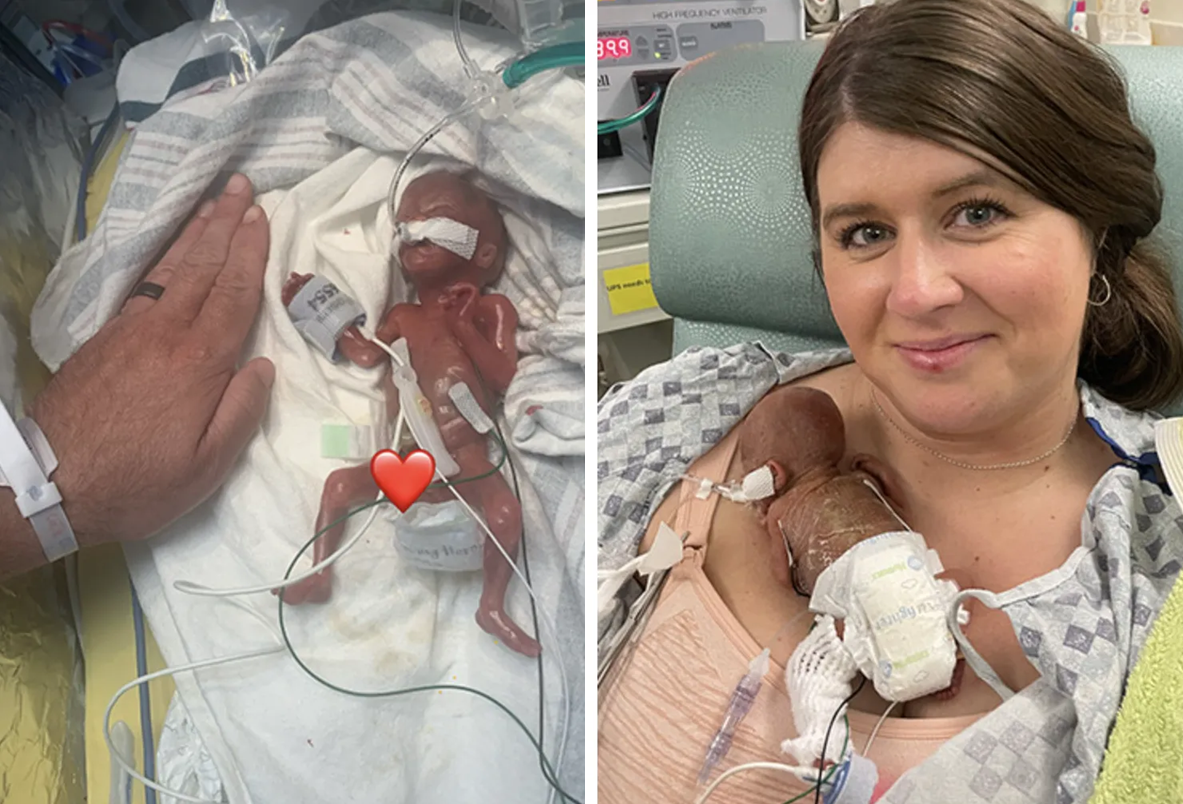 Em bé "sinh non nhất thế giới" nặng 285 gam, dài 24cm khi mới chào đời, sau 1 năm giờ ra sao?- Ảnh 1.