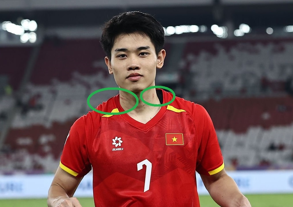 Chân sút số một U23 Việt Nam bị cầu thủ Indonesia bóp cổ, lên nhận giải thưởng vẫn còn hiện rõ vết thương - Ảnh 2.