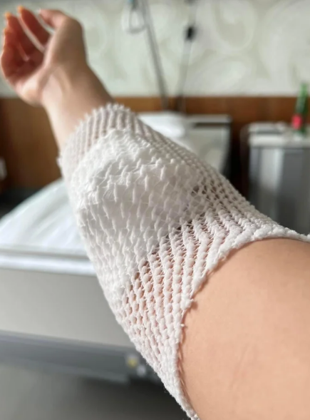 Á hậu Việt mắc bệnh lạ: Có túi nước bẩm sinh trong ổ bụng, 1 năm phải đi hút 2 lần- Ảnh 9. Á hậu Việt mắc bệnh lạ: Có túi nước bẩm sinh trong ổ bụng, 1 năm phải đi hút 2 lần- Ảnh 9.