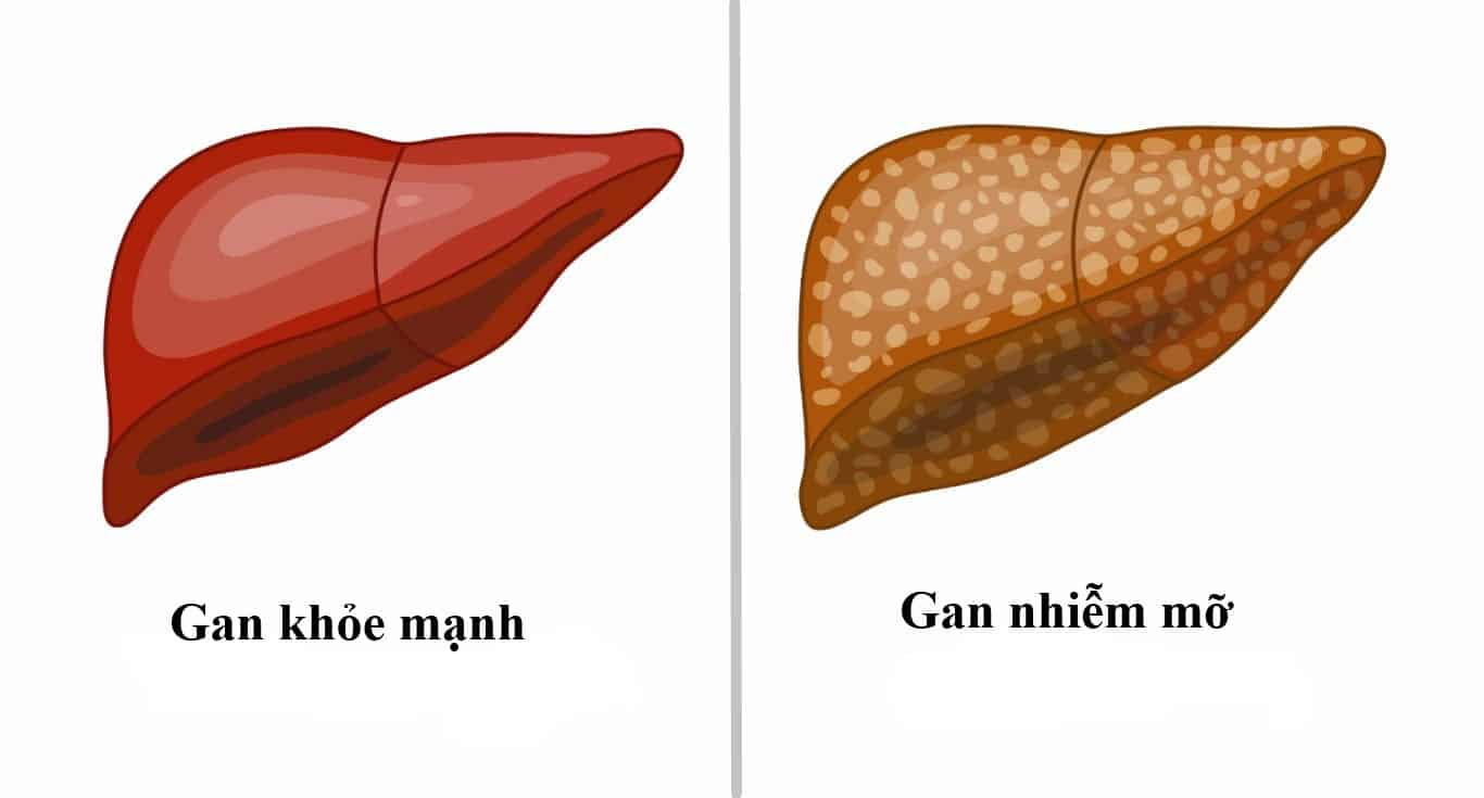 Bé trai 9 tuổi đã bị xơ gan, bác sĩ khuyến cáo thay đổi 1 điều trong ăn uống nhưng cha mẹ bỏ qua khiến bệnh càng nặng- Ảnh 3.