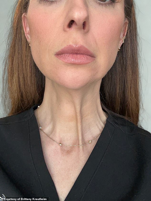 Tiêm botox vào một nửa khuôn mặt để xem ảnh hưởng thế nào đến vẻ bề ngoài: Nữ y tá "gây sốt" khi hé lộ kết quả!- Ảnh 3.