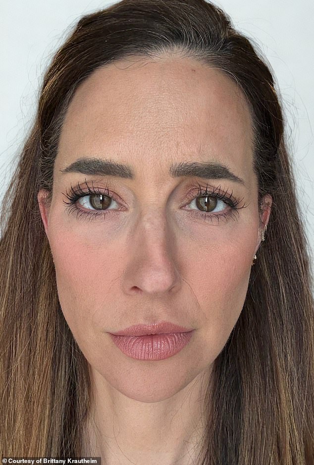 Tiêm botox vào một nửa khuôn mặt để xem ảnh hưởng thế nào đến vẻ bề ngoài: Nữ y tá "gây sốt" khi hé lộ kết quả!- Ảnh 1.