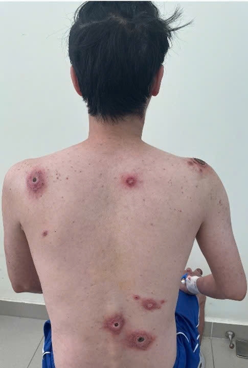 Vết lo&eacute;t tự l&agrave;nh &ndash; Dấu hiệu ban đầu của căn bệnh t&igrave;nh dục chết người- Ảnh 1.