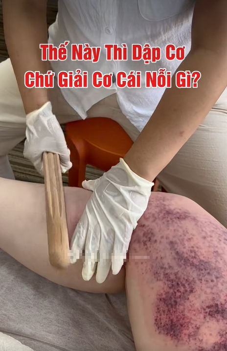 Rùng mình xem clip giải cơ lan truyền MXH, cận cảnh da thịt bị đập bầm tím ai nấy sợ hãi, xót xa- Ảnh 1. Rùng mình xem clip giải cơ lan truyền MXH, cận cảnh da thịt bị đập bầm tím ai nấy sợ hãi, xót xa- Ảnh 1.
