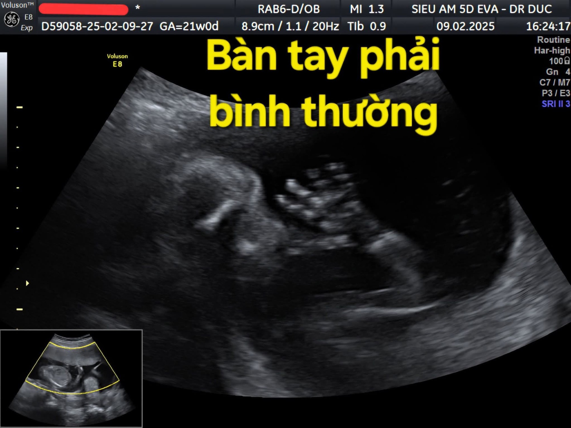 Thai Nhi 21 Tuần Bị Cắt Cụt Các Ngón Tay Vì Một Thứ Thai Nhi 21 Tuần Bị Cắt Cụt Các Ngón Tay Vì Một Thứ