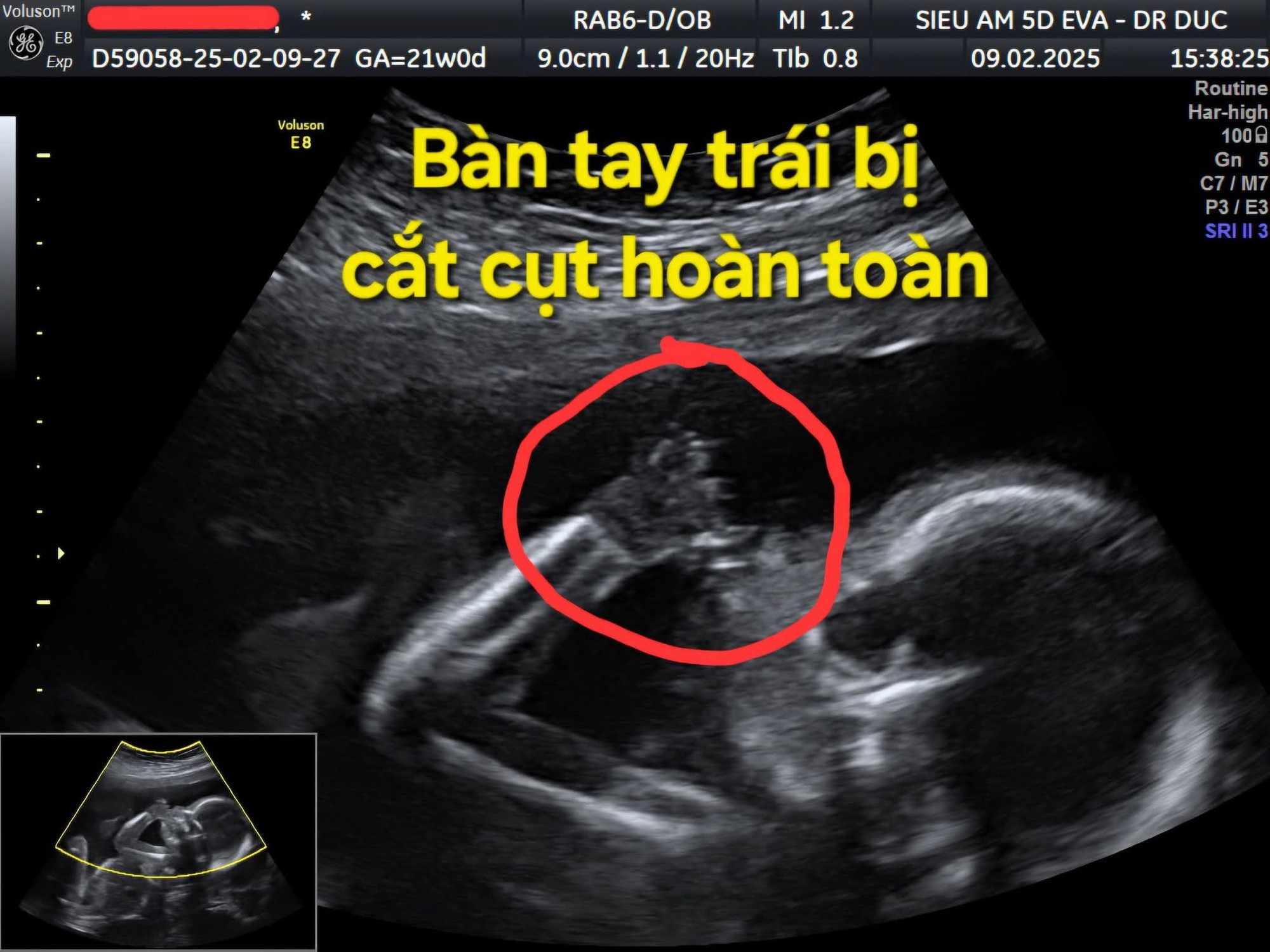 Thai Nhi 21 Tuần Bị Cắt Cụt Các Ngón Tay Vì Một Thứ Thai Nhi 21 Tuần Bị Cắt Cụt Các Ngón Tay Vì Một Thứ