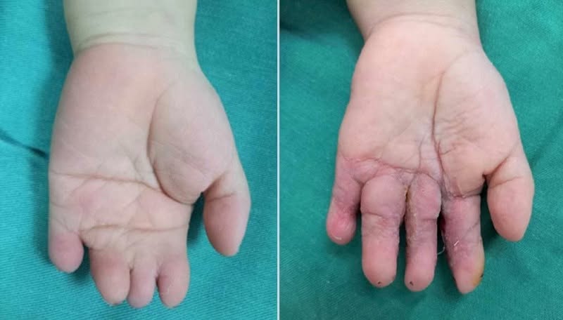 Thai Nhi 21 Tuần Bị Cắt Cụt Các Ngón Tay Vì Một Thứ Thai Nhi 21 Tuần Bị Cắt Cụt Các Ngón Tay Vì Một Thứ
