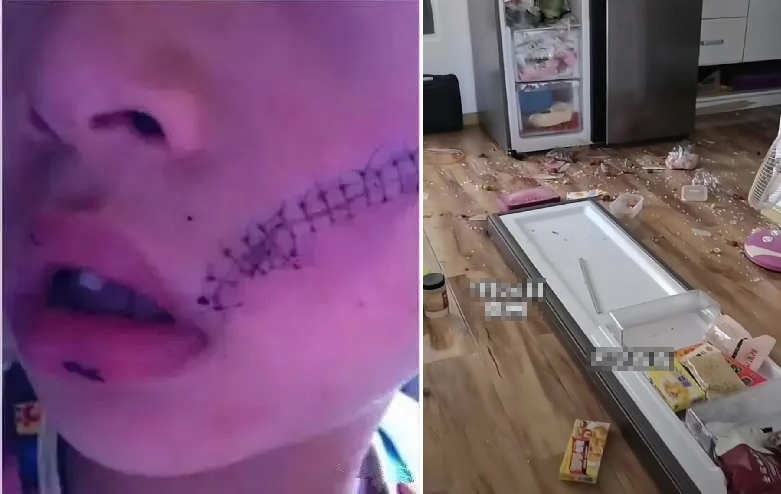 Mở tủ lạnh, bé trai 6 tuổi phải khâu 38 mũi trên mặt- Ảnh 1.