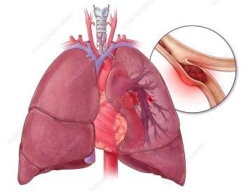 Suýt Chết Vì Dùng Thuốc Tránh Thai Suốt 10 Năm- Ảnh 1. Suýt Chết Vì Dùng Thuốc Tránh Thai Suốt 10 Năm- Ảnh 1.