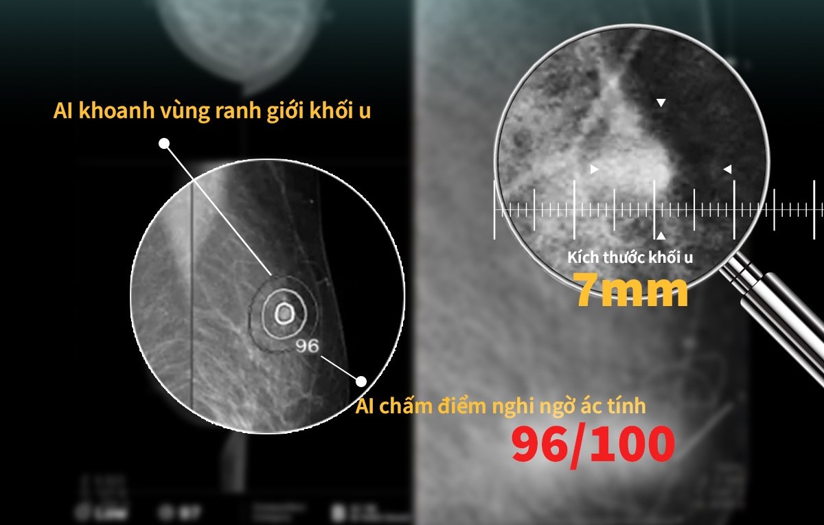 3 thứ tr&ecirc;n cơ thể m&agrave; tế b&agrave;o ung thư &ldquo;ĐẶC BIỆT Y&Ecirc;U TH&Iacute;CH&rdquo;, kh&aacute;m định kỳ vẫn dễ để lọt khối u- Ảnh 3.
