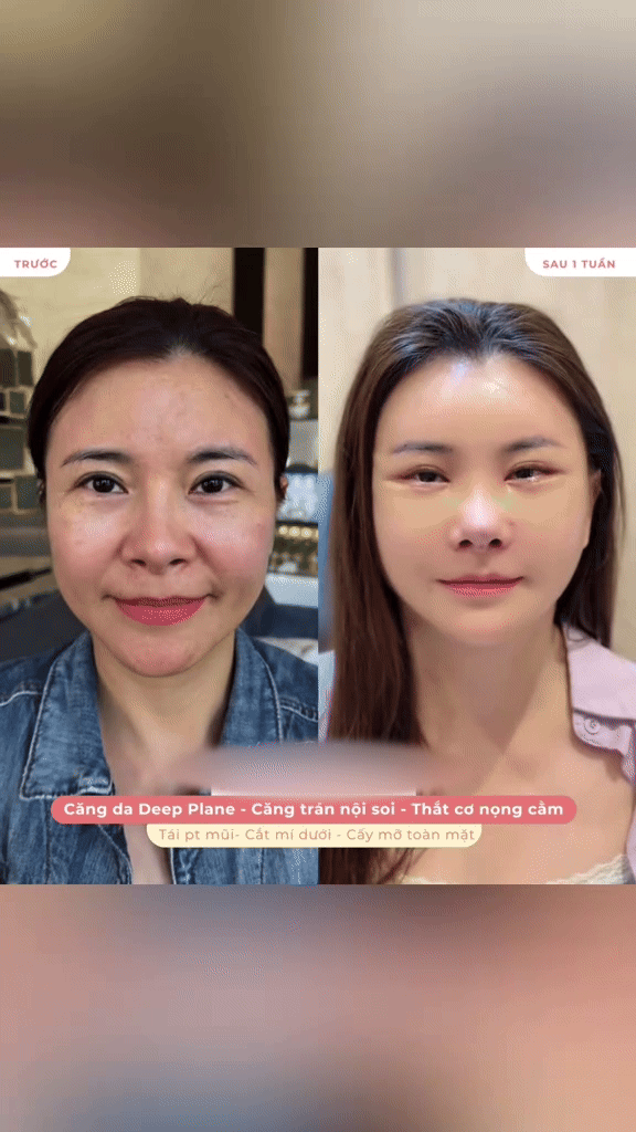 Diễn viên Kim Oanh công khai mặt mộc hậu trùng tu ở Hàn Quốc, đẹp thế nào mà dàn sao vào khen tới tấp?- Ảnh 3. Diễn viên Kim Oanh công khai mặt mộc hậu trùng tu ở Hàn Quốc, đẹp thế nào mà dàn sao vào khen tới tấp?- Ảnh 3.