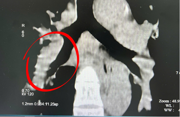 Su&yacute;t nguy kịch v&igrave; biến chứng hiếm gặp của thuốc tr&aacute;nh thai - Ảnh 2.