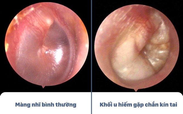 Tưởng Viêm Tai Giữa Ra Là Khối U Cholesteatoma Chắn Kín Tai Bé 3 Tuổi - Ảnh 1. Tưởng Viêm Tai Giữa Ra Là Khối U Cholesteatoma Chắn Kín Tai Bé 3 Tuổi - Ảnh 1.