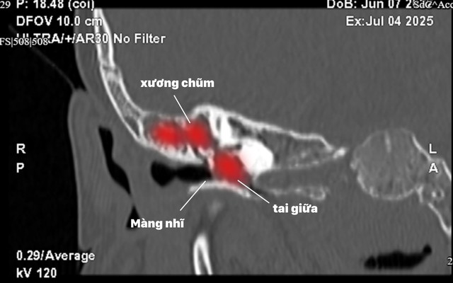 Tưởng Viêm Tai Giữa Ra Là Khối U Cholesteatoma Chắn Kín Tai Bé 3 Tuổi - Ảnh 2. Tưởng Viêm Tai Giữa Ra Là Khối U Cholesteatoma Chắn Kín Tai Bé 3 Tuổi - Ảnh 2.