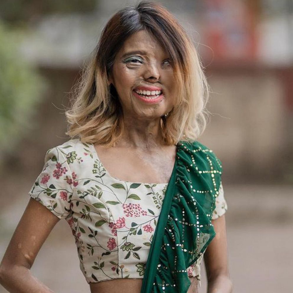 Bé gái bị cha tạt axit vì "không phải con trai" khi mới 2 tháng tuổi, tưởng không sống được bao lâu nào ngờ hiện tại có cuộc đời đáng kinh ngạc - Ảnh 4.