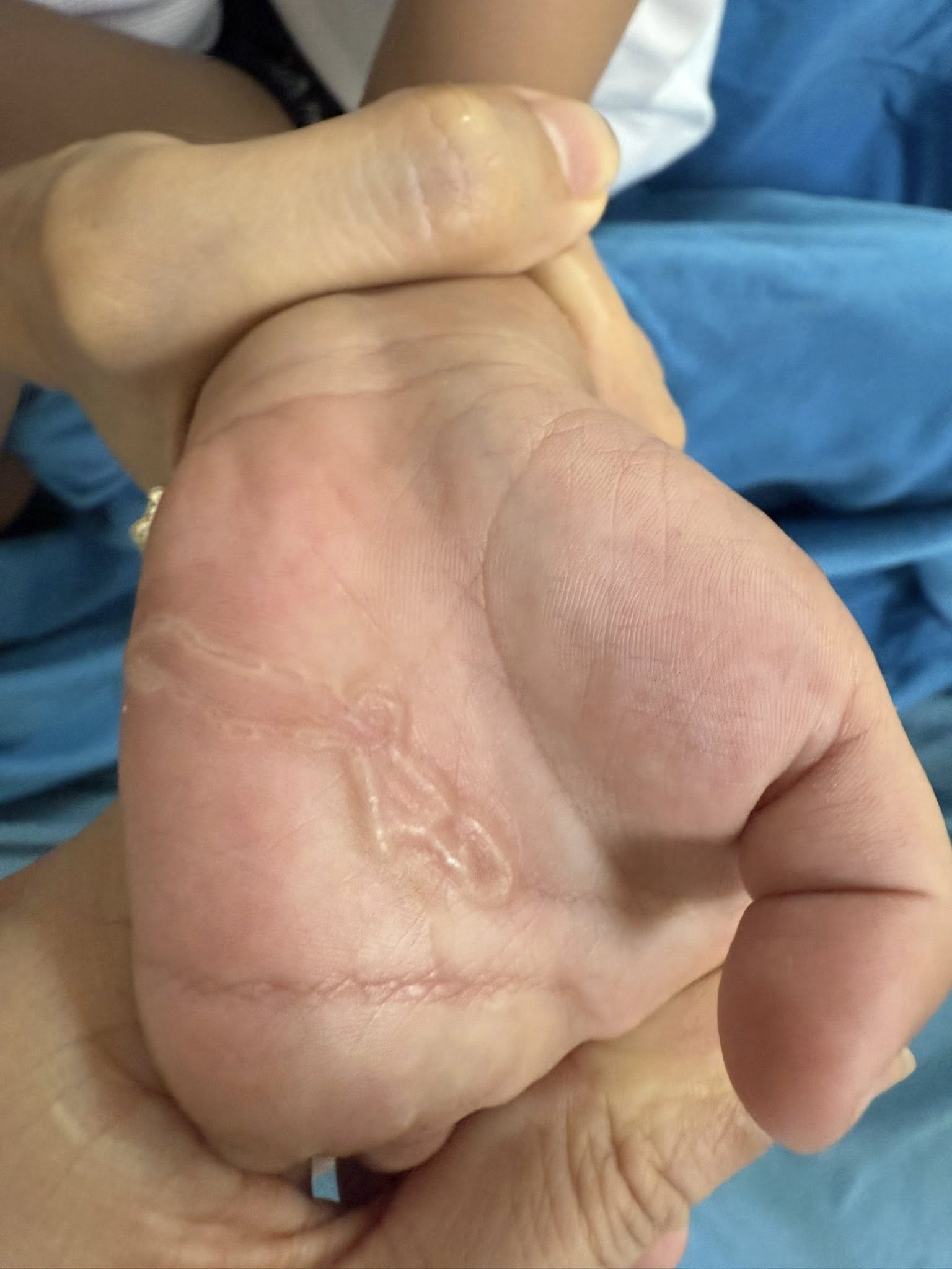 Bàn tay bé trai xuất hiện dấu hiệu lạ sau lần nghịch cát - Ảnh 1.