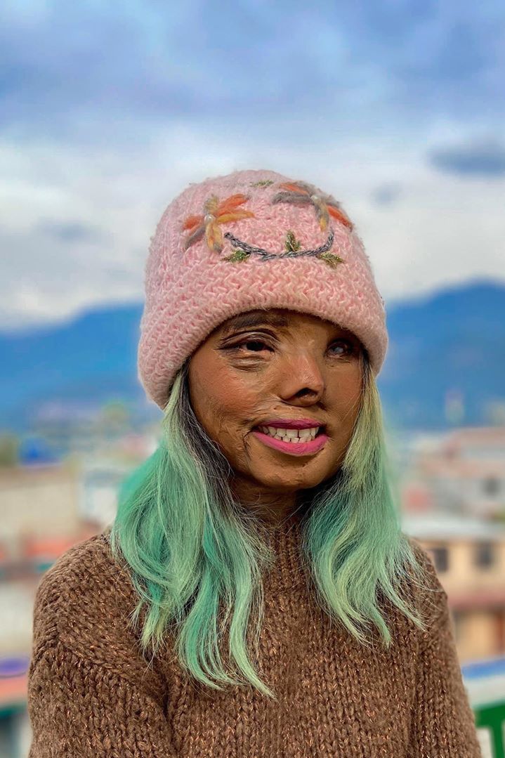 Bé gái bị cha tạt axit vì "không phải con trai" khi mới 2 tháng tuổi, tưởng không sống được bao lâu nào ngờ hiện tại có cuộc đời đáng kinh ngạc - Ảnh 2.