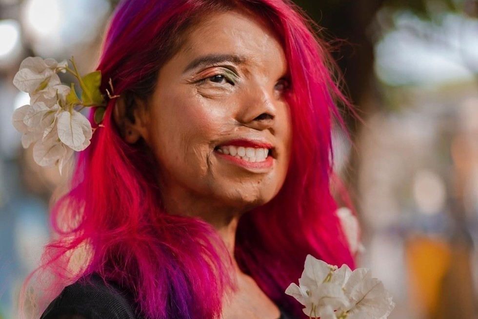 Bé gái bị cha tạt axit vì "không phải con trai" khi mới 2 tháng tuổi, tưởng không sống được bao lâu nào ngờ hiện tại có cuộc đời đáng kinh ngạc - Ảnh 5.