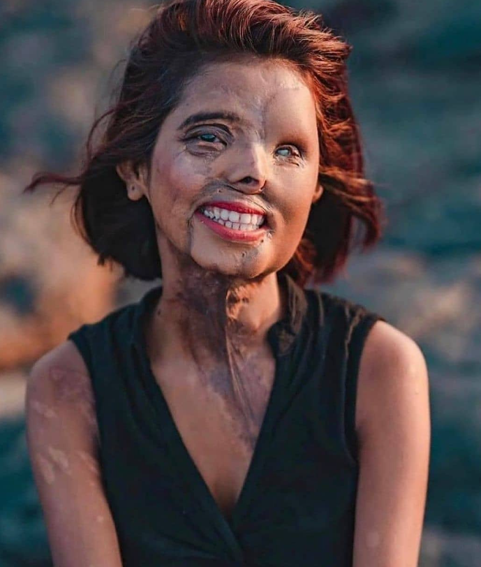 Bé gái bị cha tạt axit vì "không phải con trai" khi mới 2 tháng tuổi, tưởng không sống được bao lâu nào ngờ hiện tại có cuộc đời đáng kinh ngạc - Ảnh 8.