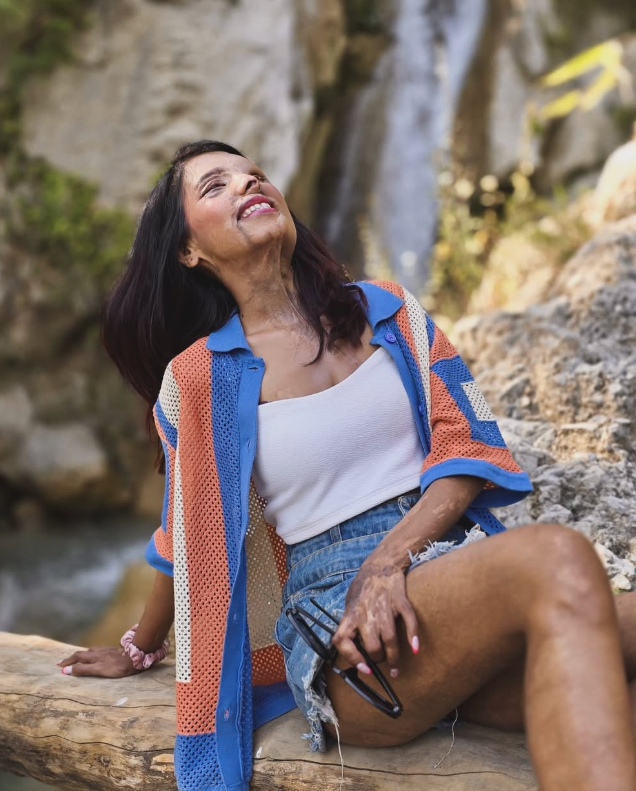 Bé gái bị cha tạt axit vì "không phải con trai" khi mới 2 tháng tuổi, tưởng không sống được bao lâu nào ngờ hiện tại có cuộc đời đáng kinh ngạc - Ảnh 7.