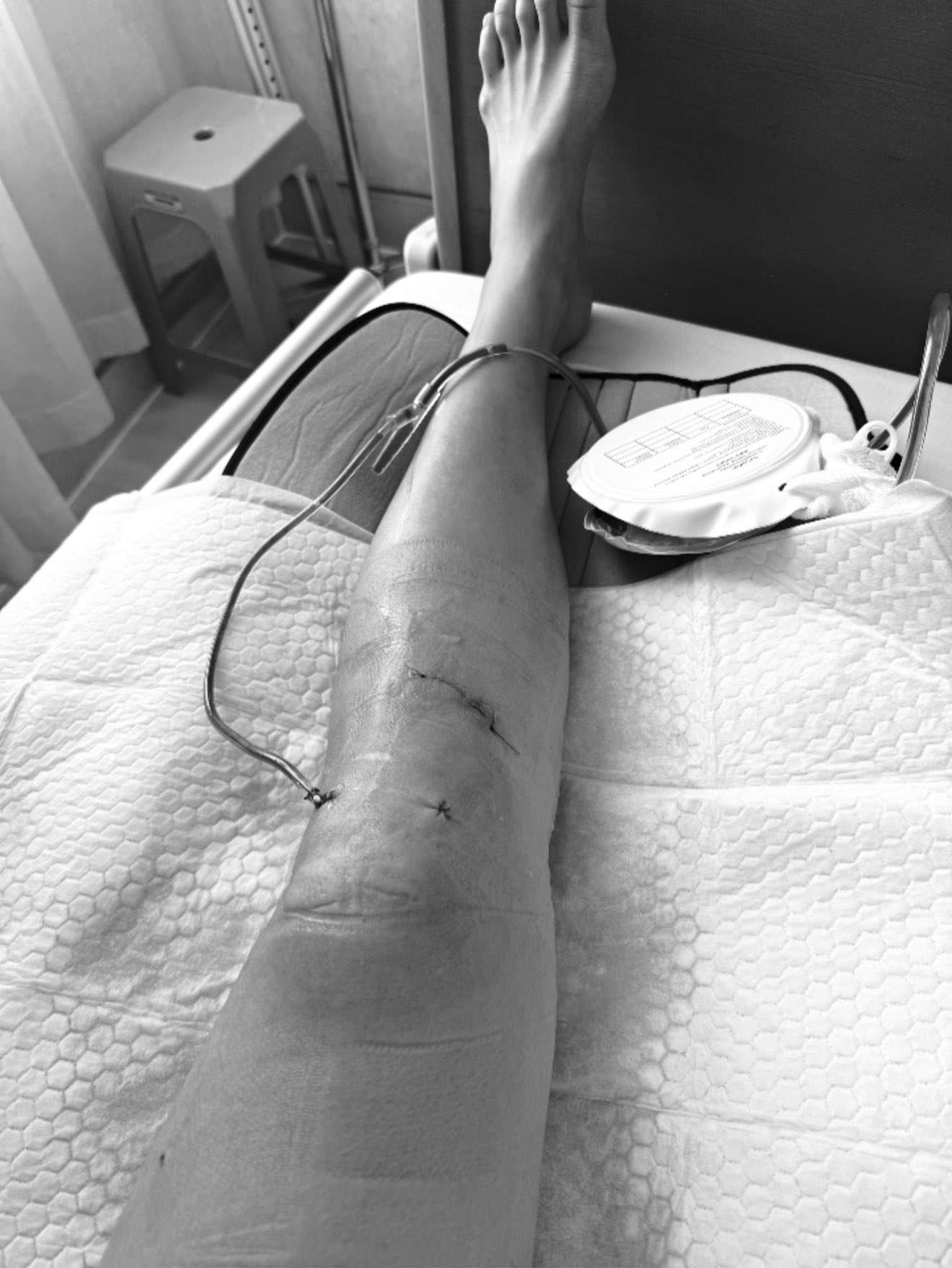 Siêu mẫu Minh Tú sốc vì bị đứt dây chằng chéo trước, rách sụn, dập xương - Ảnh 1.