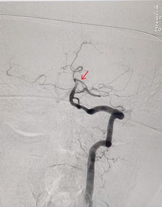 Chích lể đầu ngón tay chữa đột quỵ, một người đàn ông suýt mất mạng - Ảnh 2. Chích lể đầu ngón tay chữa đột quỵ, một người đàn ông suýt mất mạng - Ảnh 2.