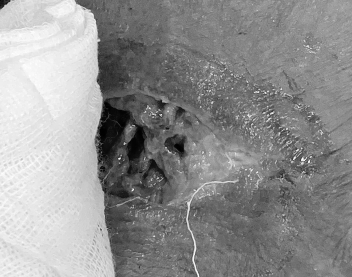 R&ugrave;ng m&igrave;nh: Gi&ograve;i b&ograve; lổn nhổn b&ecirc;n trong vết thương v&ugrave;ng cổ- Ảnh 1.