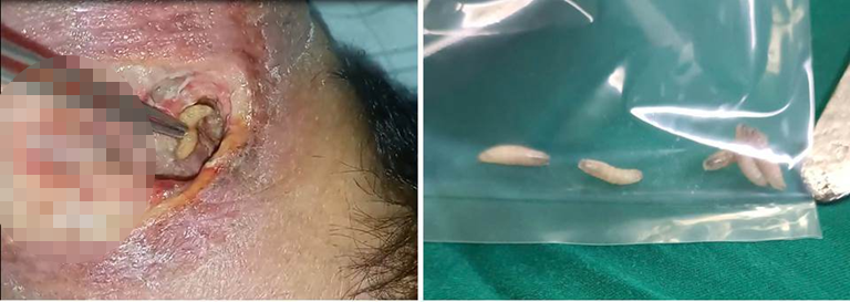 R&ugrave;ng m&igrave;nh: Gi&ograve;i b&ograve; lổn nhổn b&ecirc;n trong vết thương v&ugrave;ng cổ- Ảnh 2.