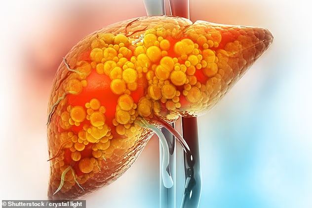 'Nhấp' vài lon bia mỗi tối, thanh niên suýt mất mạng vì mỡ máu tăng vọt - Ảnh 2.