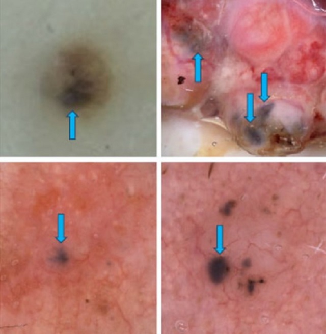 Đi nước ngoài đốt nốt ruồi, về nước phát hiện ung thư - Ảnh 1.