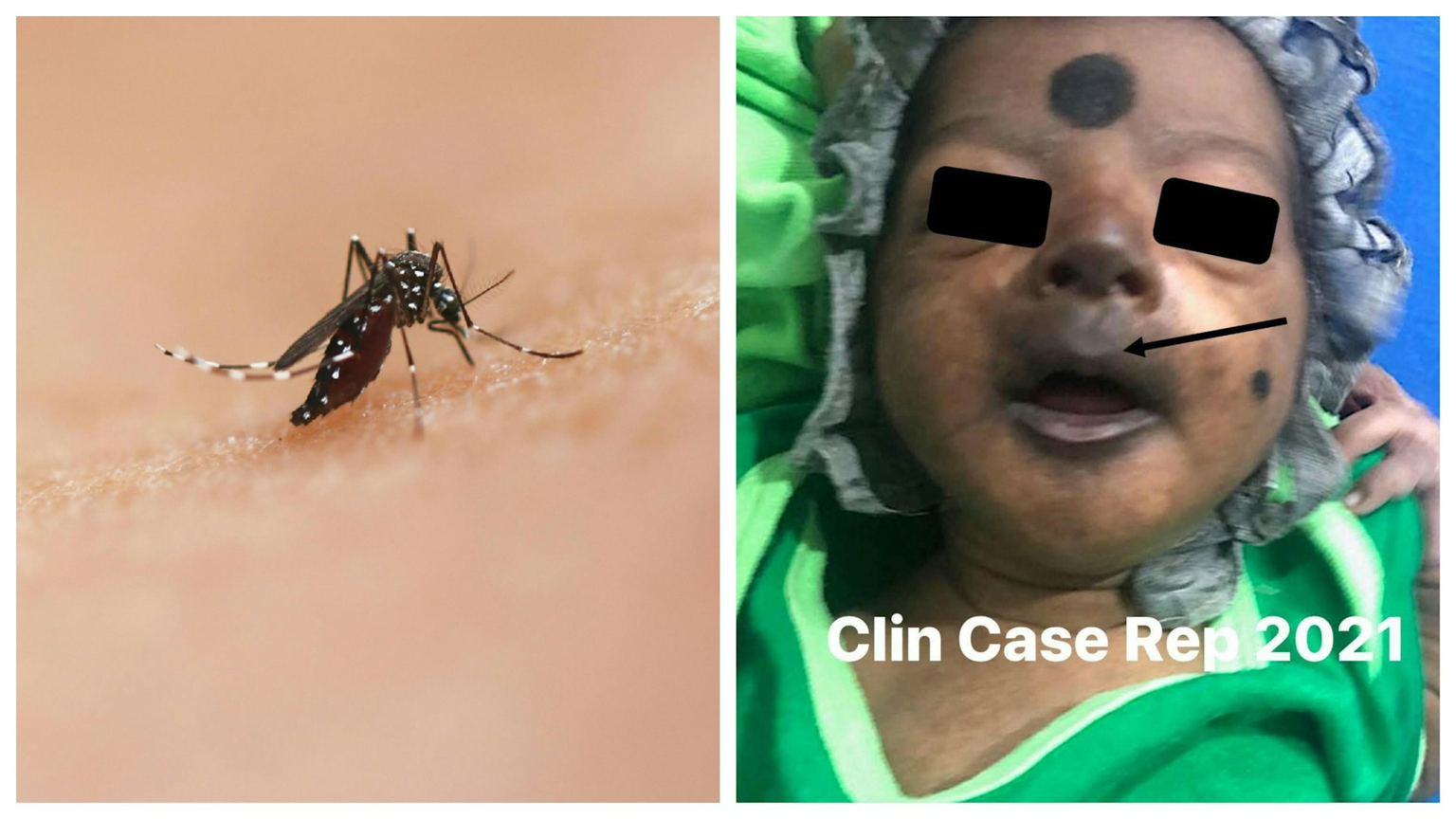 Bé trai 12 ngày tuổi mặt tím đen vì nhiễm virus Chikungunya có thể "phá hủy nội tạng"- Ảnh 1.