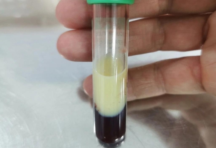 'Nhấp' vài lon bia mỗi tối, thanh niên suýt mất mạng vì mỡ máu tăng vọt - Ảnh 1.